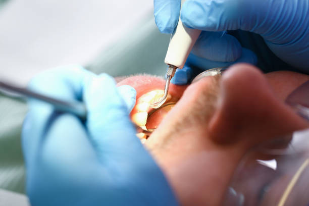 Best Emergency Root Canal Treatment in Helotes, TX