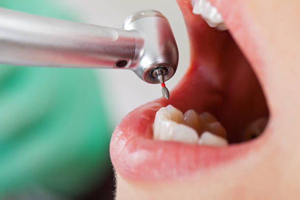 Best Broken or Cracked Tooth Emergency Dentist in Helotes, TX